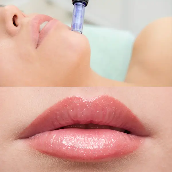 faciales hidra lips