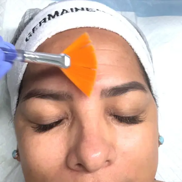 faciales peelings