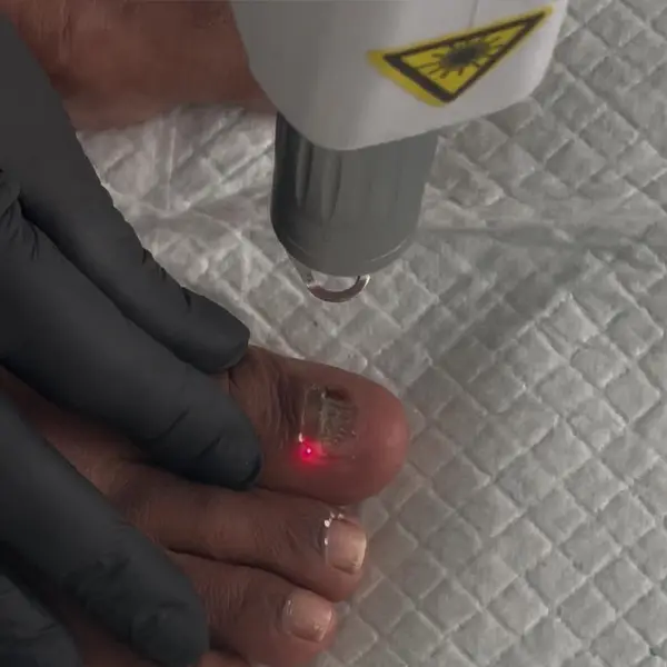 laser onimicosis