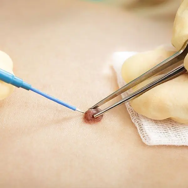 laser verrugas acrocodones